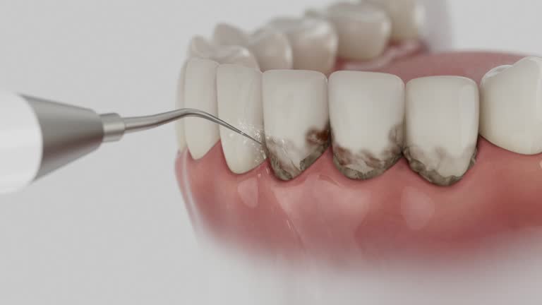 Trusted Wisdom Tooth Removal service in Boulder, CO - Dentist Open Now
